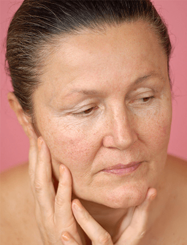 How Niacinamide Serum Helps Reduce Redness and Rosacea Symptoms - Caire Beauty