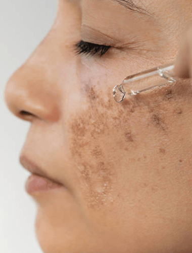 How to Fight Hyperpigmentation and Age Spots for Mature Skin - Caire Beauty