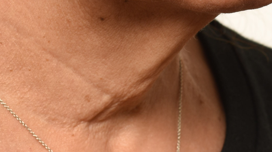 Skin before four weeks of use